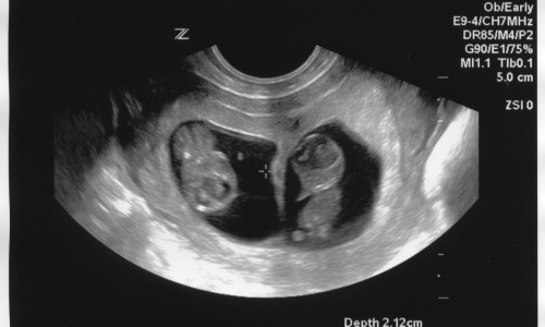 Ultrasound Twins