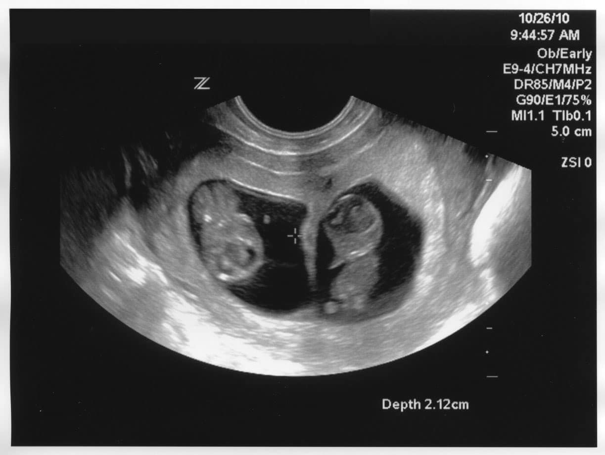 Ultrasound Twins | EmergencyMD